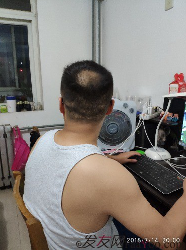济南植发案例，给你看前后对比图