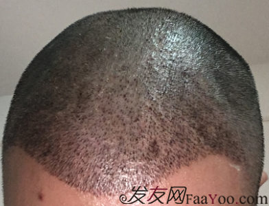 广州植发记，3680单位记录植发效果！
