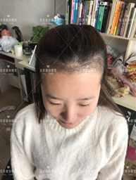 发际线调整案例——很幸运，重新变回小仙女