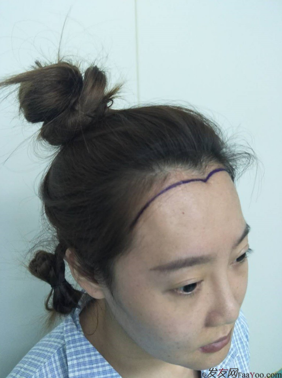 北京南加发际线调整案例种植头发成功案例