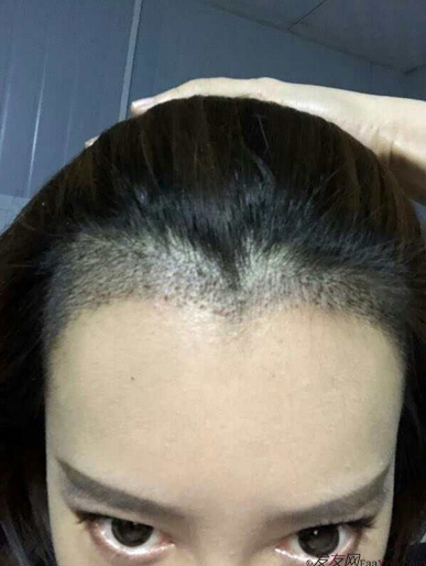 北京南加发际线调整案例种植头发成功案例