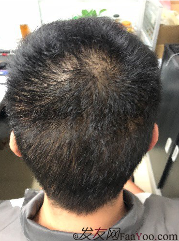 二次植发，发现不一样的自己，植发记录贴