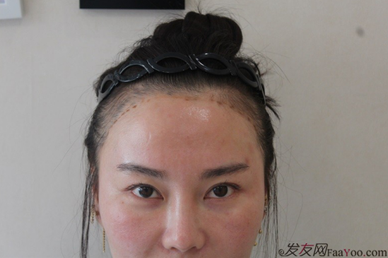 北京南加发际线种植，银盆大脸终于修炼成了邻家幼幼