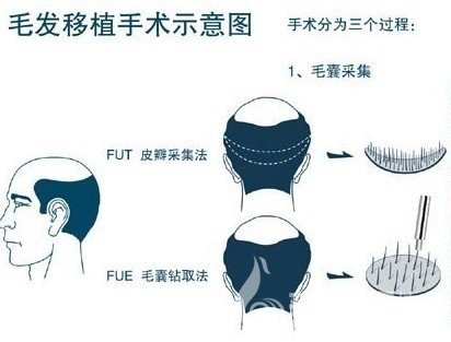 厦门那里植发技术较好