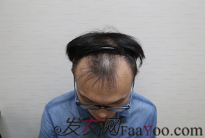 广州新发现植发，现在恢复的很好了感谢发友网熊二哥哥