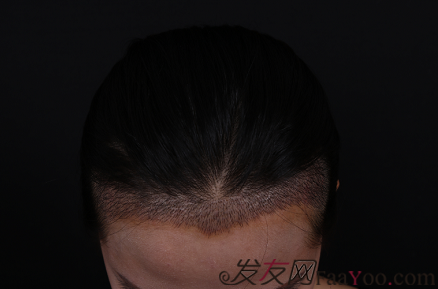 我在北京植了发，谢谢发友网给我的帮助，分享植发日记