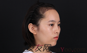  我在北京微美植发，调整发际线后，大额头终于不见了