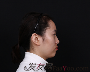  我在北京微美植发，调整发际线后，大额头终于不见了
