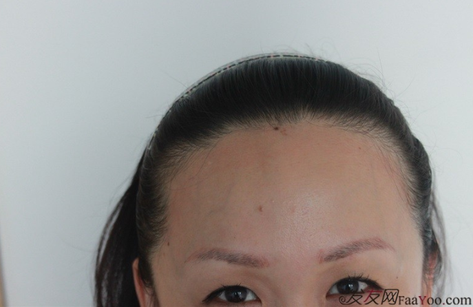 北京南加高主任眉毛+发际线种植术后一年啦，大家看看如何