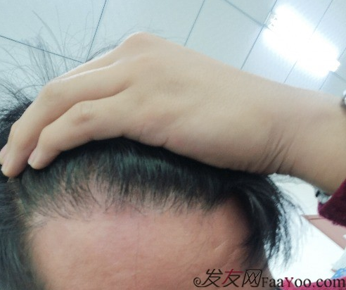 天津新发现植发3000单位，我来说说有头发的感受