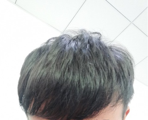 天津新发现植发3000单位，我来说说有头发的感受