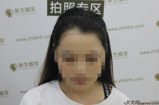 新生植发帮助我解决“美人尖”的尴尬