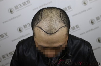 向广州新生植发致敬，治好了我的N级脱发！