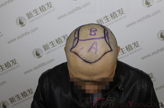 向广州新生植发致敬，治好了我的N级脱发！