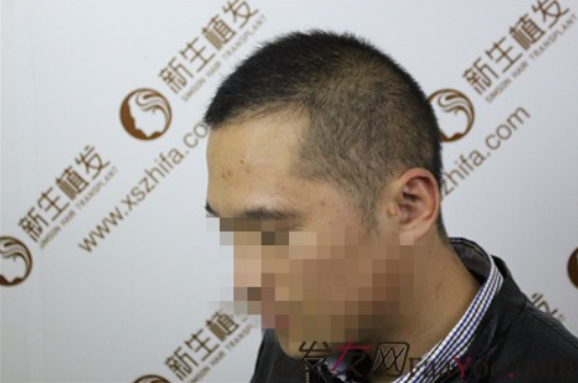 向广州新生植发致敬，治好了我的N级脱发！