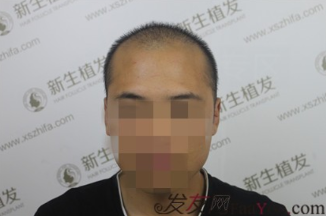 向广州新生植发致敬，治好了我的N级脱发！