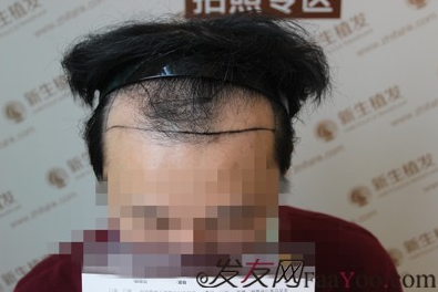 相约广州新生植发，拯救M型脱发！