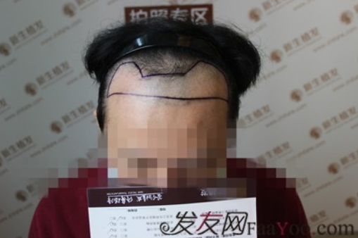 相约广州新生植发，拯救M型脱发！