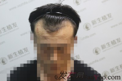 拼搏的年纪遇上脱发，我只能选择去广州新生植发了