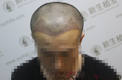拼搏的年纪遇上脱发，我只能选择去广州新生植发了