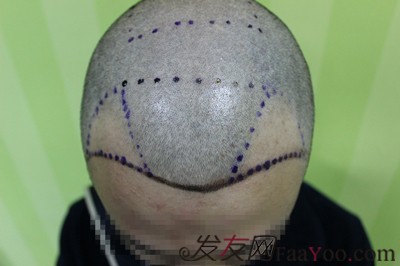发际线移植，广州新生植发11个月后大变样