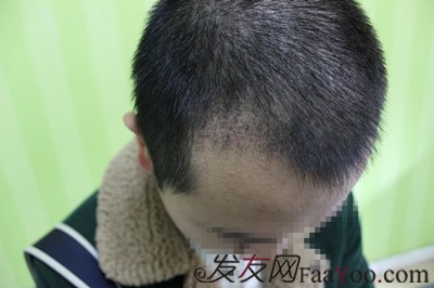 发际线移植，广州新生植发11个月后大变样