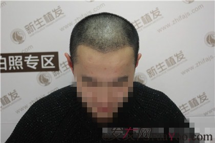 因为杭州新生植发，相亲不再被拒绝