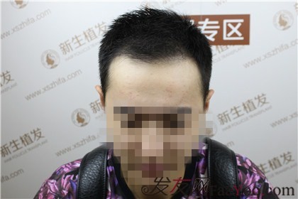 因为杭州新生植发，相亲不再被拒绝