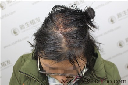 杭州新生植发医院，一场脱发困扰与时髦造型的博弈 