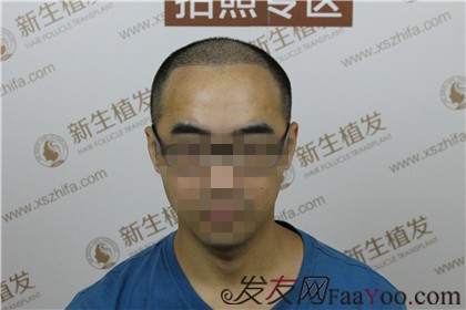 广州新生植发案例，努力奋斗在脱单的路上