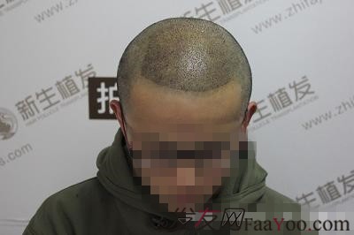 南京新生植发3500单位，爱美之心人皆有之