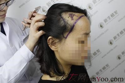 南京新生植发，真实植发前后对比图