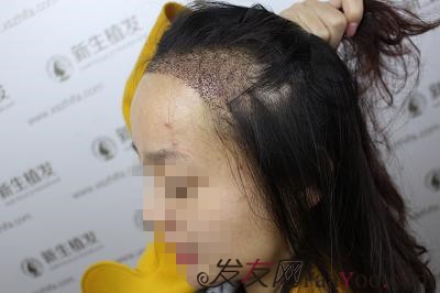 南京新生植发，真实植发前后对比图
