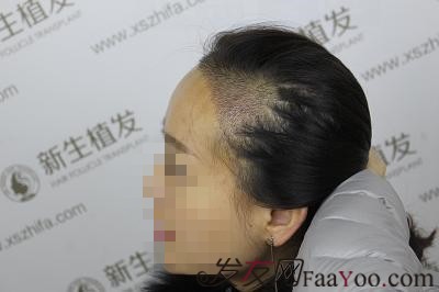 南京新生植发，真实植发前后对比图
