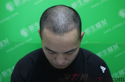 6级脱发在广州新生植发后成了这样，来看看前后对比图