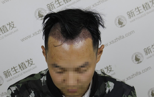 南京新生植发2500单位，亲身经历感觉南京新生真是太给力了