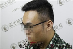 广州新生植发，植完发后他们都说我变了