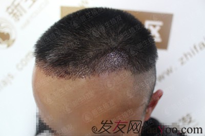 广州新生植发发际线种植，自此以后又多了一个纪念日
