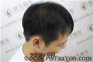 6级脱发，广州新生植发对我做了什么！