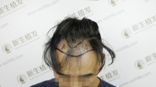 广州新生植发后，一年前后对比图重焕新生！