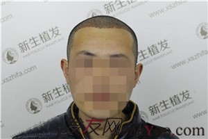 广州新生的3级脱发植发经历，2200毛囊单位快来看看