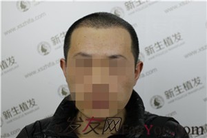广州新生的3级脱发植发经历，2200毛囊单位快来看看