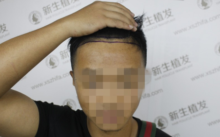 南京新生植发，早发现早治疗跟脱发说拜拜
