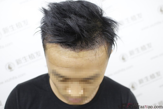 南京新生植发，早发现早治疗跟脱发说拜拜