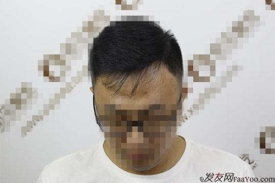 南京新生植发案例植发这事拖不得，越拖越脱！