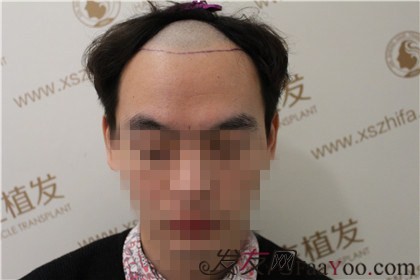 杭州新生植发案例，这家医院可谓是脱发的终结者