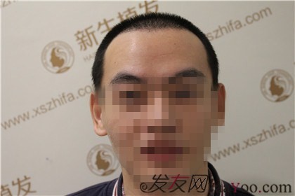 杭州新生植发案例，这家医院可谓是脱发的终结者