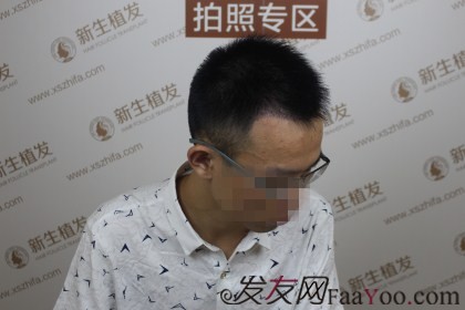 杭州新生植发1500单位，额头变小帅气变大