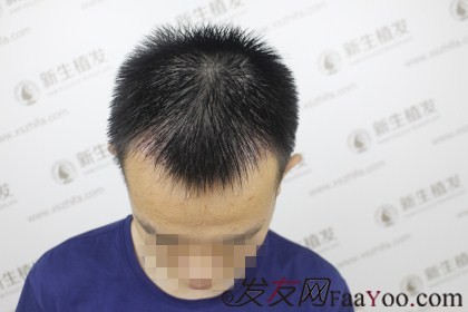 杭州新生植发1500单位，额头变小帅气变大