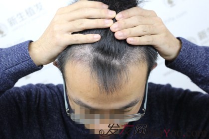杭州新生植发1500单位，额头变小帅气变大